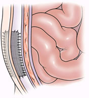 hernia-b