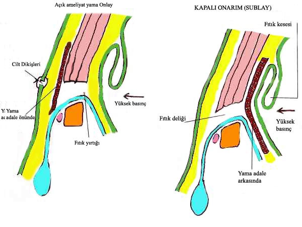kasikfitigi_tedavisi