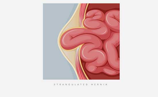 Fıtık Nedir; Neden Olur?